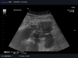 Ultrazvok ledvic - bezgavke v trebušni votlini